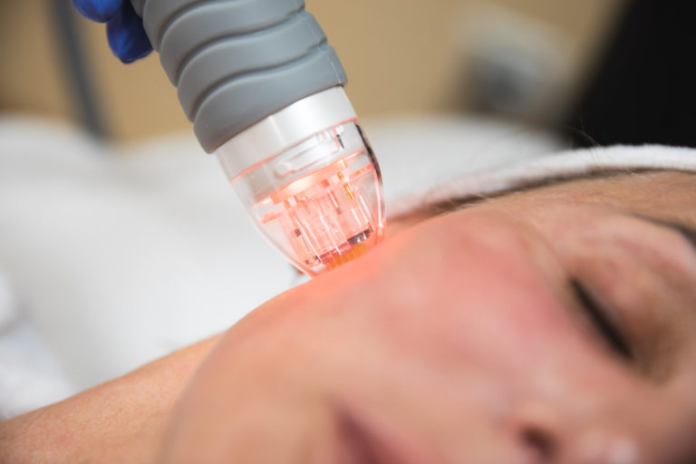A woman gets a RF microneedling skin treatment in Indianapolis
